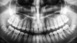 do wisdom teeth stitches dissolve or fall out