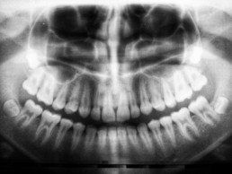 do wisdom teeth stitches dissolve or fall out